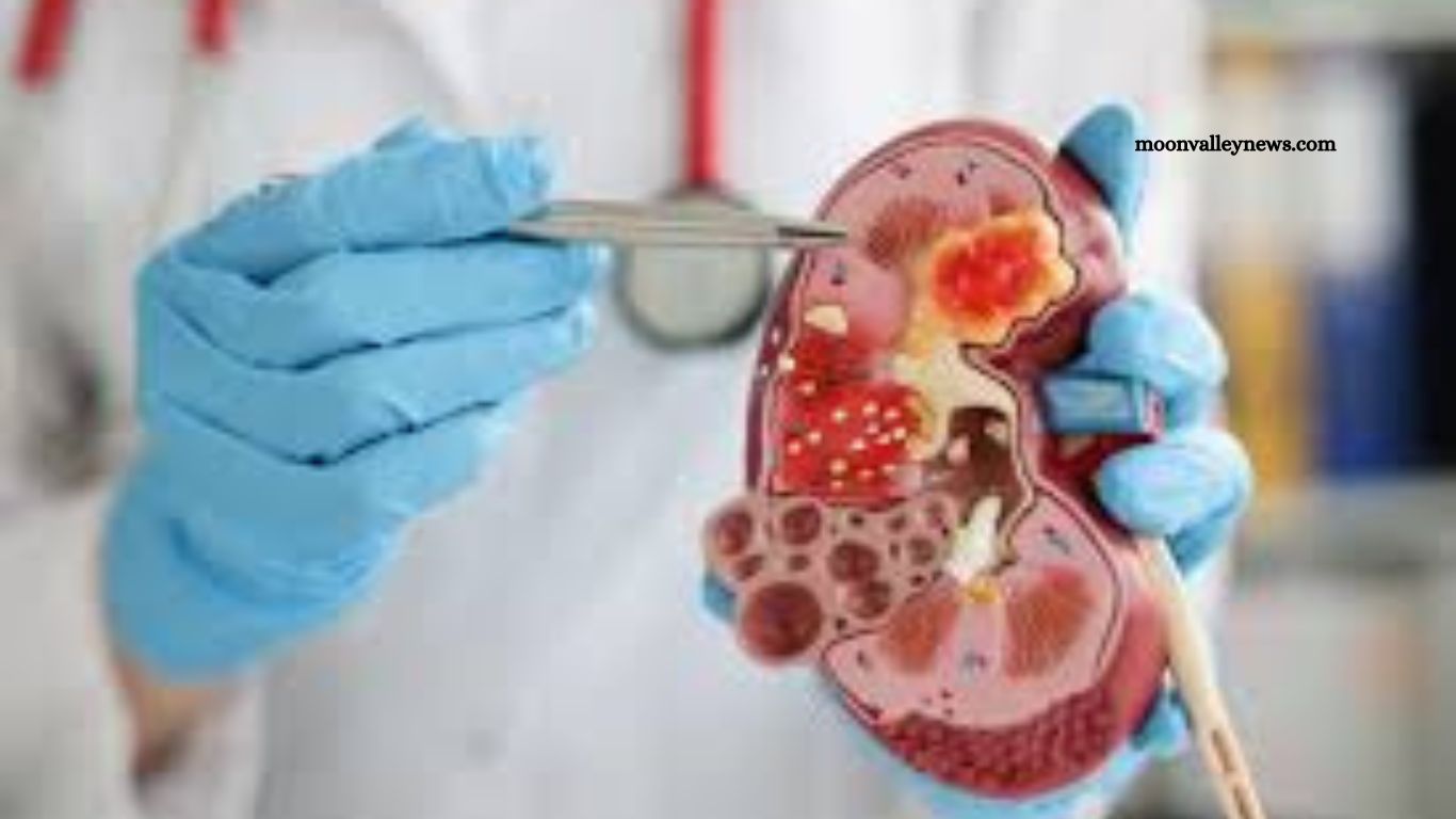 Kidney Cancer